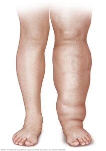 Find Relief with Our Top Lymphoedema Treatments in Newcastle