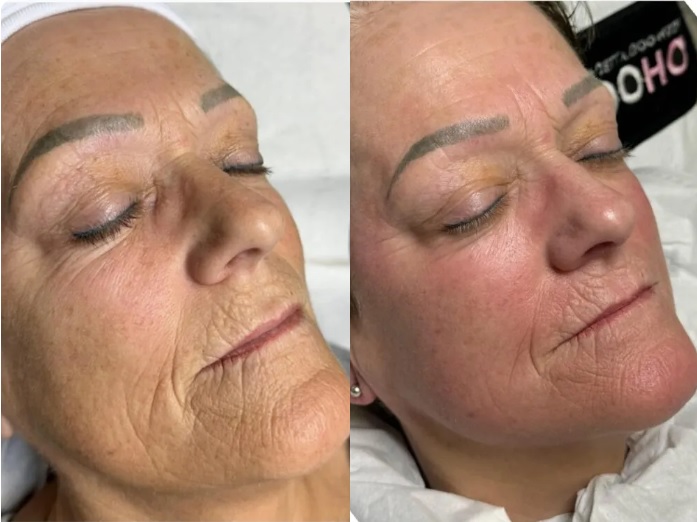 collagen lift skin tightening RF treatment newcastle