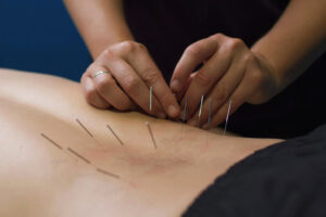 Therapist performing dry needling in Newcastle
