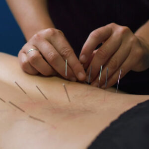 Dry Needling dry needling newcastle