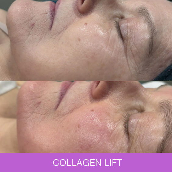 Collagen Lift & Radio Frequency Treatment Collagen Lift & Radio Frequency Treatment at Naturally Heaven Therapy Beauty Salon in Newcastle