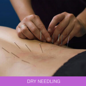 DRY NEEDLING NEWCASTLE SPORTS CLINIC